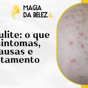 Foliculite: O Que É, Causas, Sintomas e Tratamento