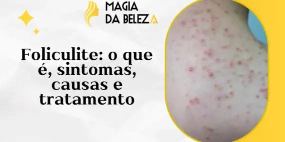 Foliculite: O Que É, Causas, Sintomas e Tratamento