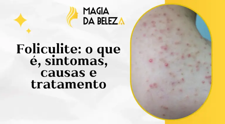Foliculite: O Que É, Causas, Sintomas e Tratamento