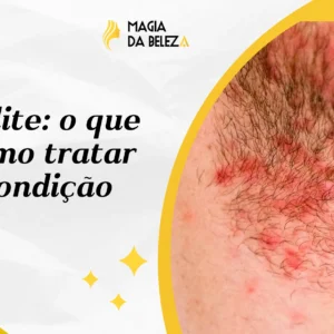 Foliculite: o que é e como tratar essa condição