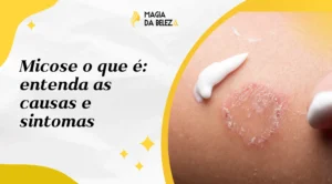 Micose o que é: entenda as causas e sintomas