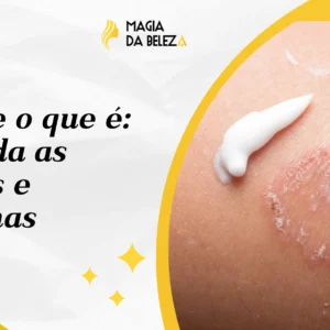 Micose o que é: entenda as causas e sintomas