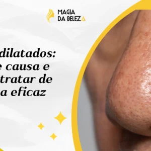 Poros dilatados: O que causa e como tratar de forma eficaz