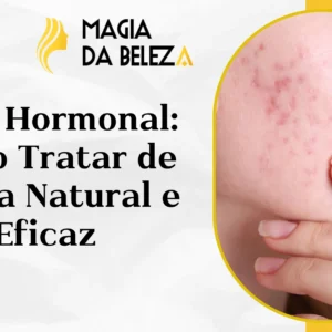 Acne Hormonal: Como Tratar de Forma Natural e Eficaz