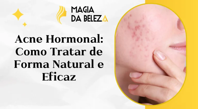 Acne Hormonal: Como Tratar de Forma Natural e Eficaz
