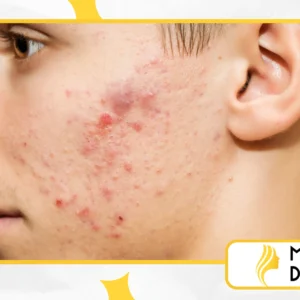 Como Tratar Acne e Espinhas com uma Rotina de Skincare Adequada