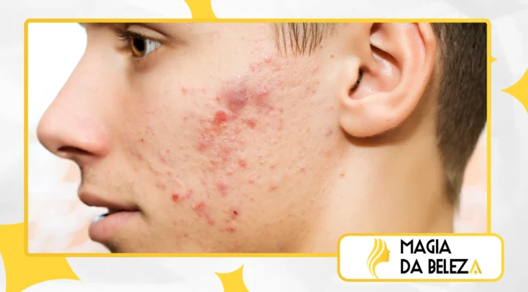 Como Tratar Acne e Espinhas com uma Rotina de Skincare Adequada