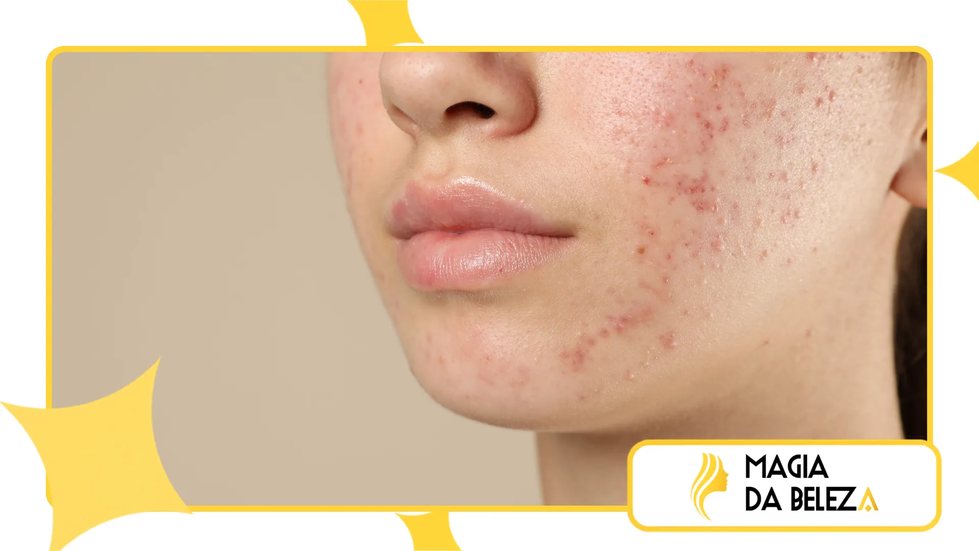 reduzir marcas de acne recentes