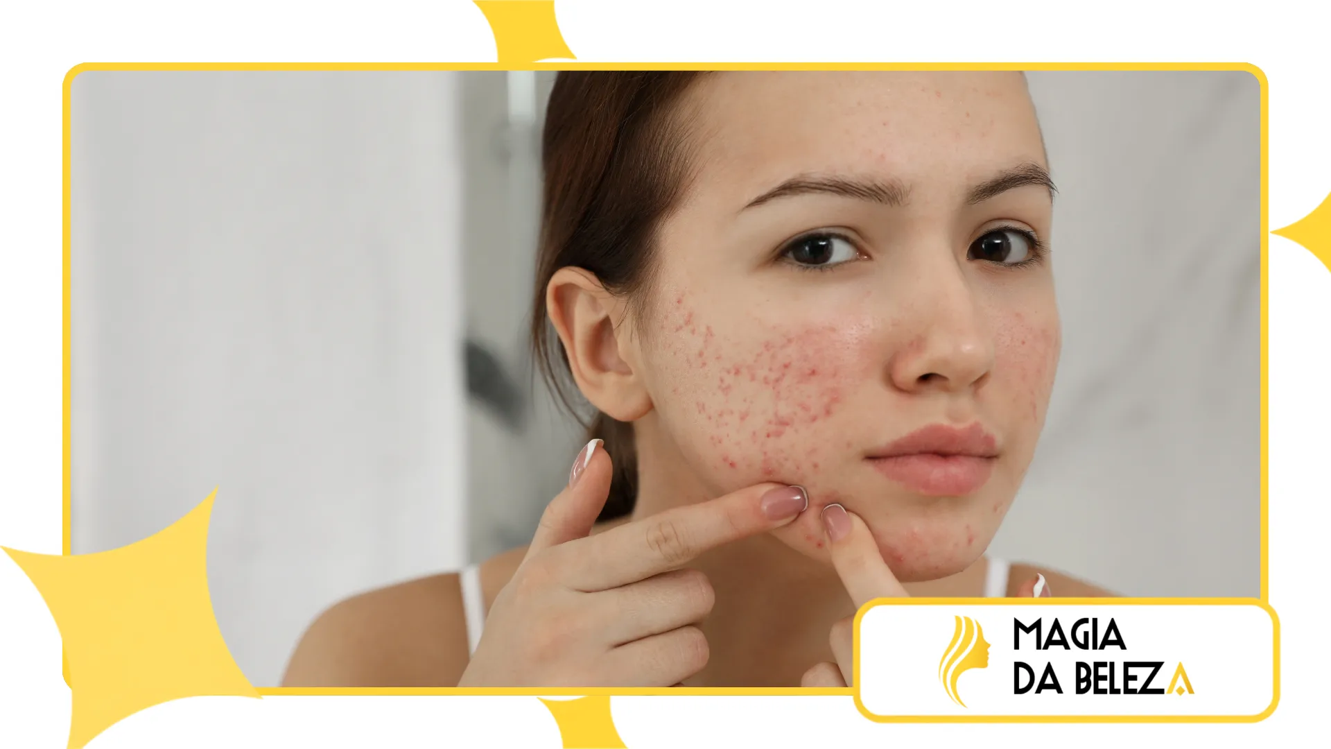 reduzir marcas de acne recentes