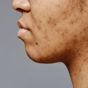 Como reduzir marcas de acne recentes com ativos modernos