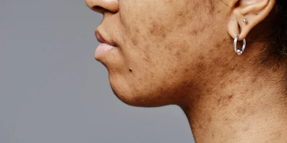 Como reduzir marcas de acne recentes com ativos modernos