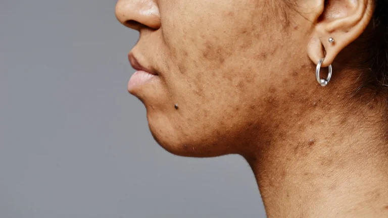 Como reduzir marcas de acne recentes com ativos modernos